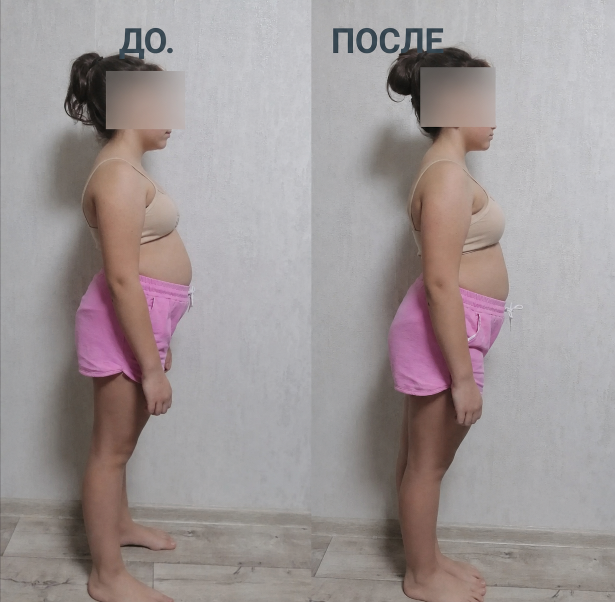 До и после работы с осанкой у девочки в профиль